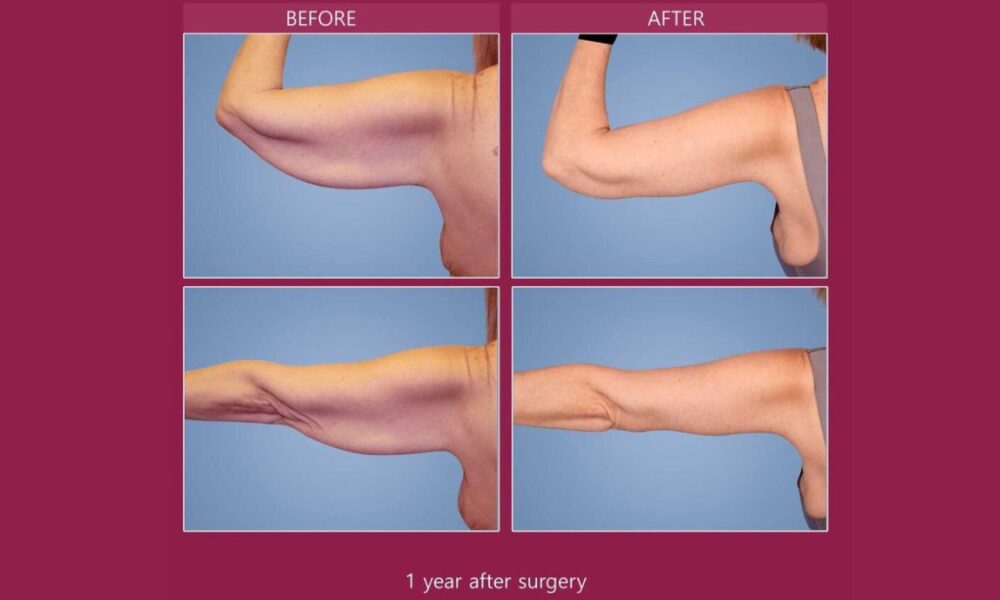 arm lift before and after