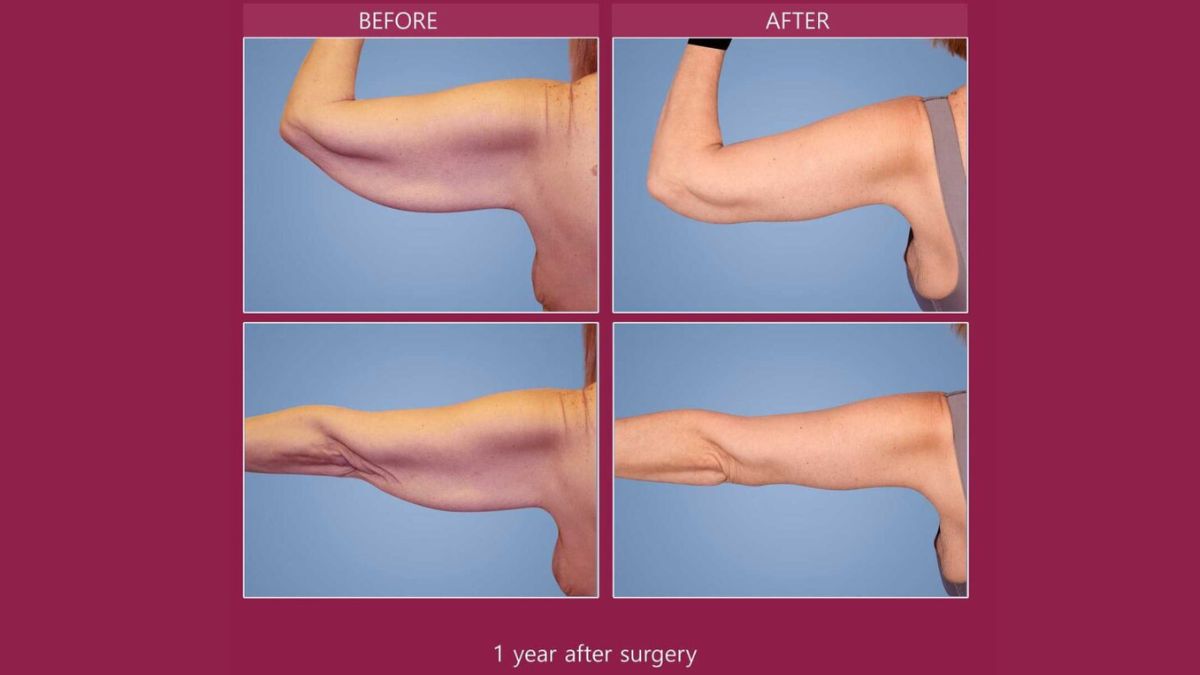 arm lift before and after