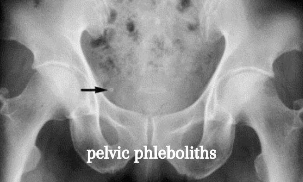 pelvic phleboliths