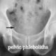 pelvic phleboliths