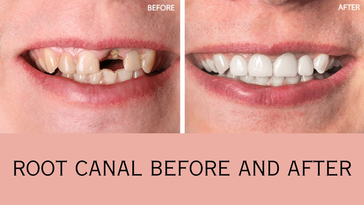 root canal before and after