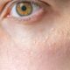 Understanding Milia: A Common Skin Condition
