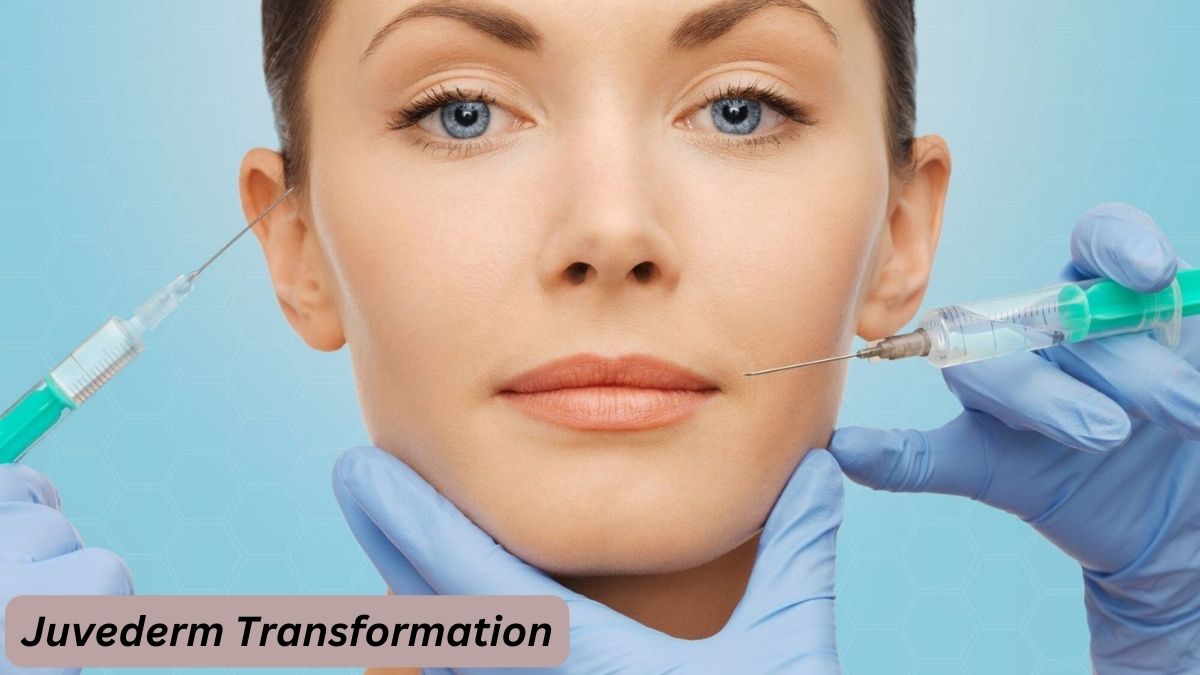 Juvederm Transformation