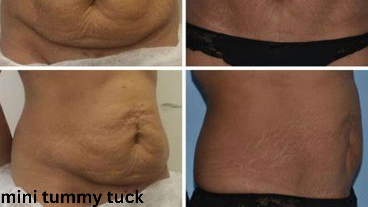 mini tummy tuck 