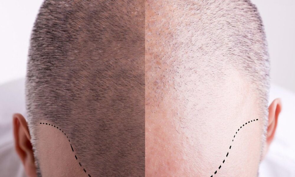 Hair Transplant Surgery Before and After