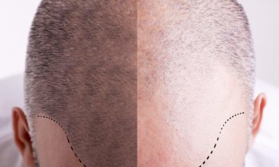 Hair Transplant Surgery Before and After