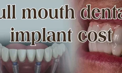 Cost of Full Mouth Dental Implants